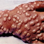 smallpox-150x150